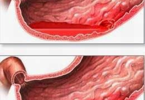 Hướng dẫn chăm sóc sau mổ phẫu thuật nội soi khâu lỗ thủng dạ dày, tá tràng